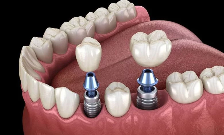 بیمه ایمپلنت