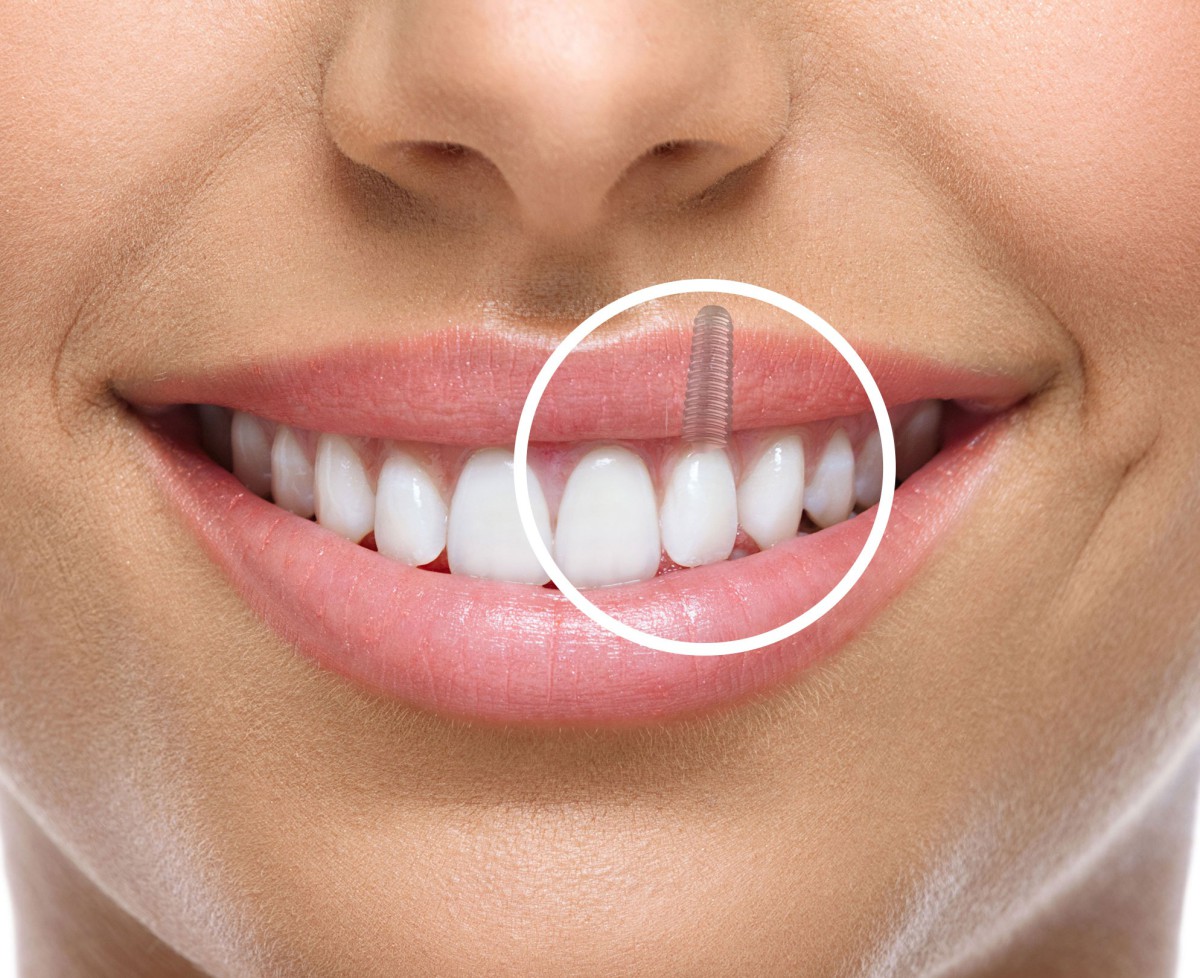 خدمات بیمه نامه ایمپلنت