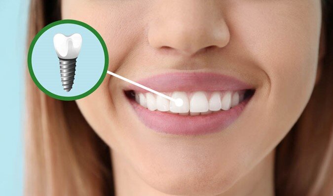 پوشش حوادث و تصادفات در بیمه ایمپلنت