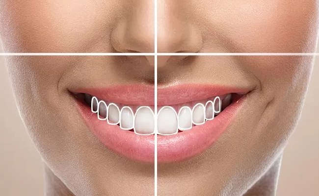 طراحی لبخند چیست