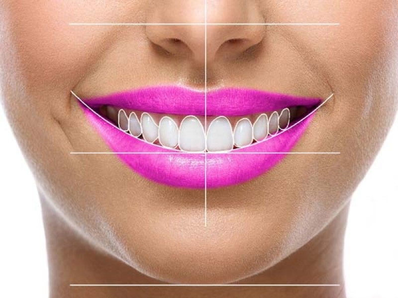 طراحی لبخند چیست