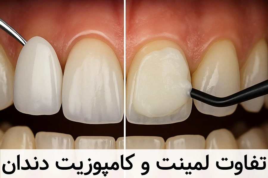 فرق لمینت و کامپوزیت دندان