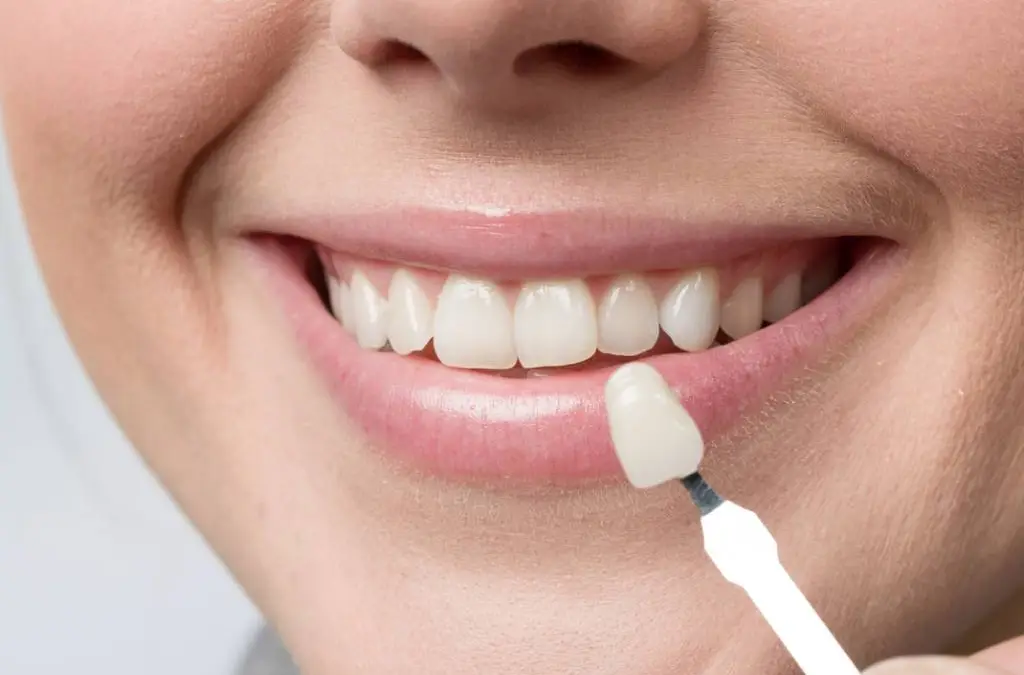 لمینت دندان چیست