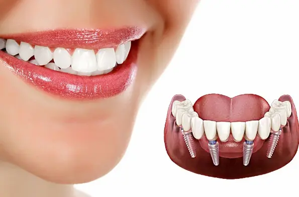 مراقبت های بعد ایمپلنت دندان