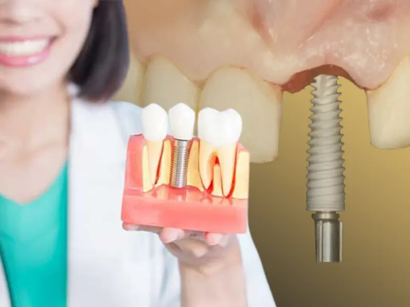 مراقبت های قبل از ایمپلنت دندان