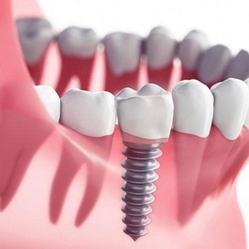 آیا ایمپلنت دندان درد دارد؟