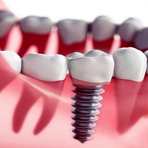 ایمپلنت فوری چیست