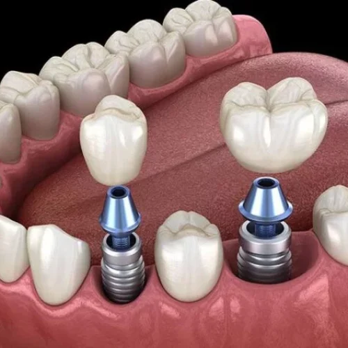 بیمه ایمپلنت