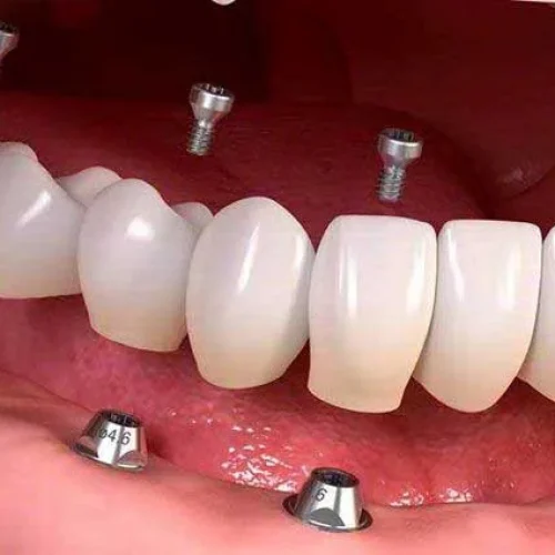 بیمه ایمپلنت در تهران