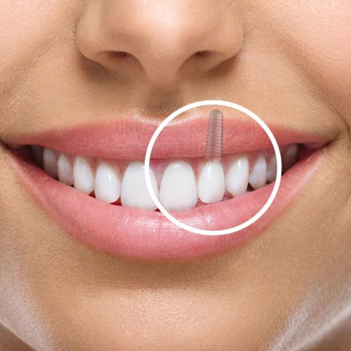 خدمات بیمه نامه ایمپلنت