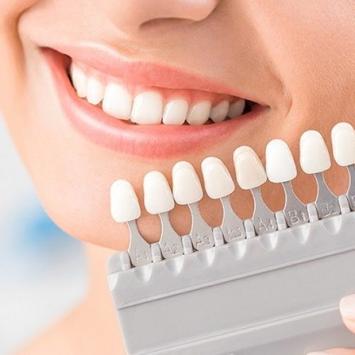 لمینت دندان چیست