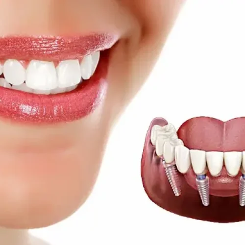 مراقبت های بعد ایمپلنت دندان