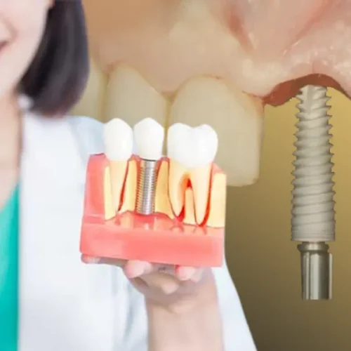 مراقبت های قبل از ایمپلنت دندان