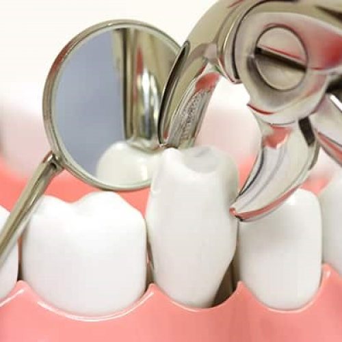 مراقبت های قبل و بعد از کشیدن دندان