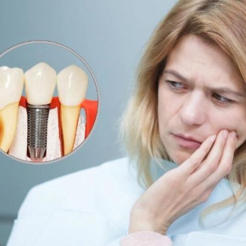 مسکن قوی برای درد ایمپلنت