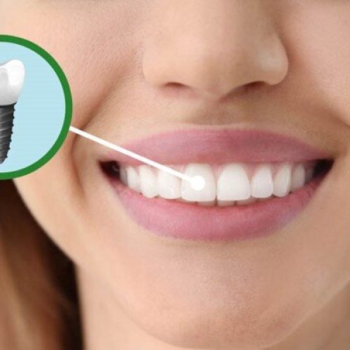 پوشش حوادث و تصادفات در بیمه ایمپلنت